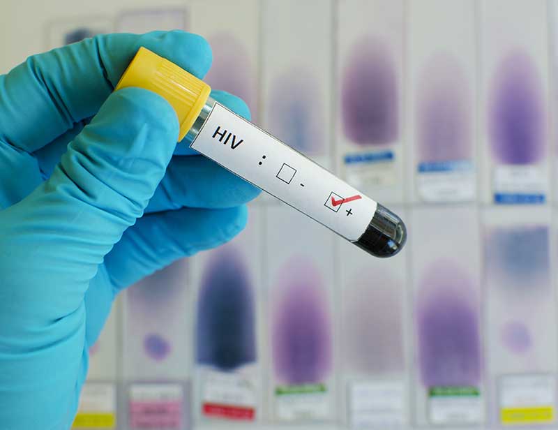  Brasil não reduz mortes e infecções por aids